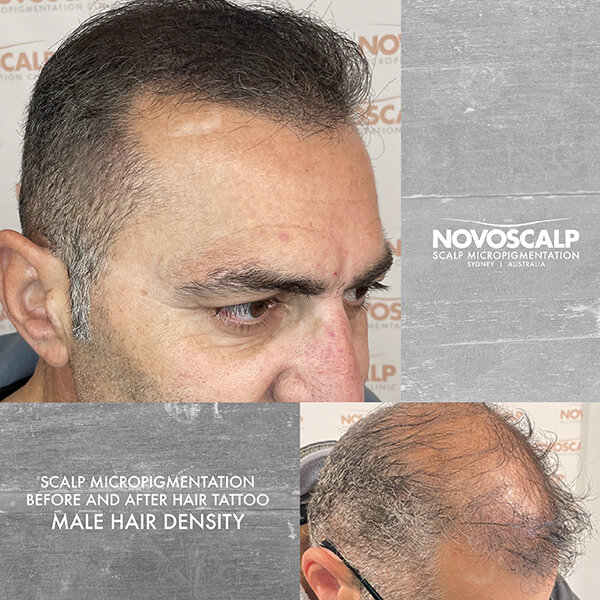 Novoscalp-sydney-smp-before-after-hair-tattoo-andy-MALE HAIR DENSITY 600px