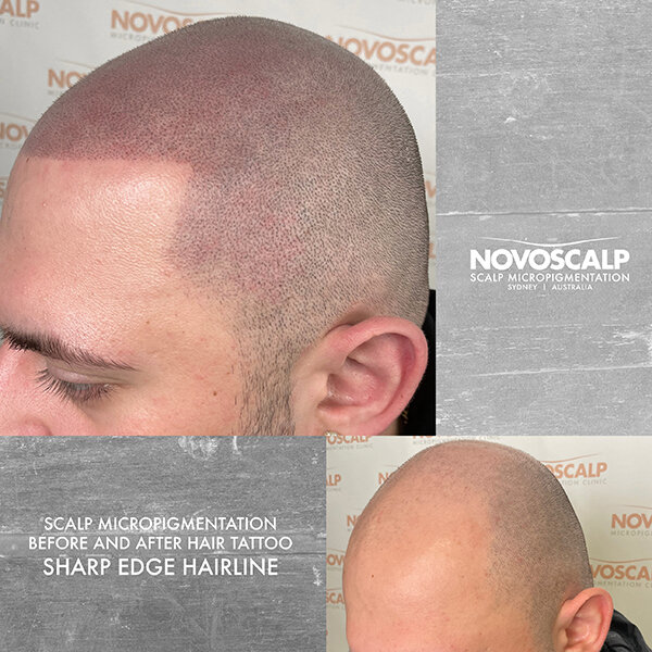 Scalp micropigmentation before and after sharp edge hairline tattoo SMP Sydney