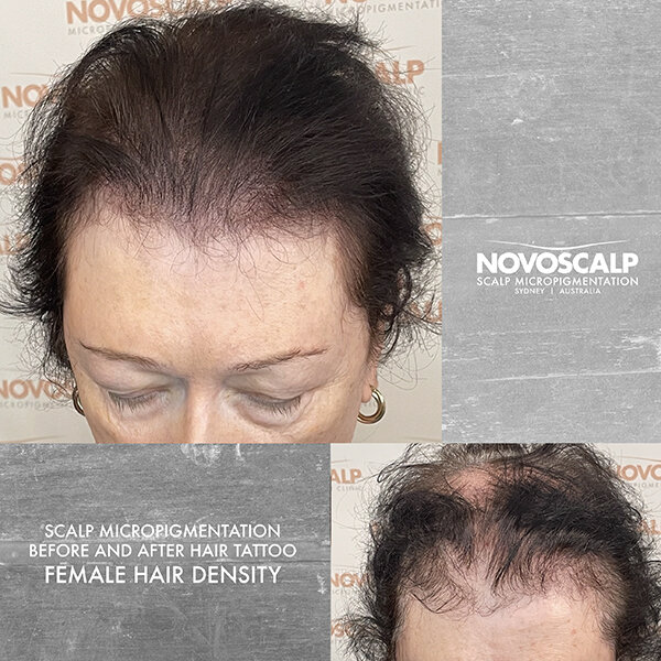 Novoscalp-sydney-smp-before-after-hair-tattoo-debrafr-FEMALE HAIR DENSITY 600px