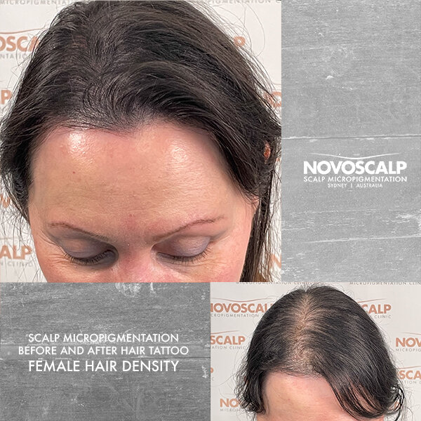 Novoscalp-sydney-smp-before-after-hair-tattoo-joann-FEMALE HAIR DENSITY 600px