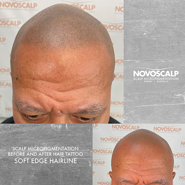 Scalp micropigmentation before and after soft edge hairline tattoo SMP Sydney