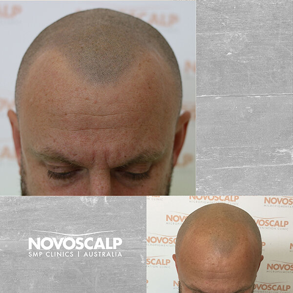 Scalp micropigmentation before and after hair tattoo for balding sydney