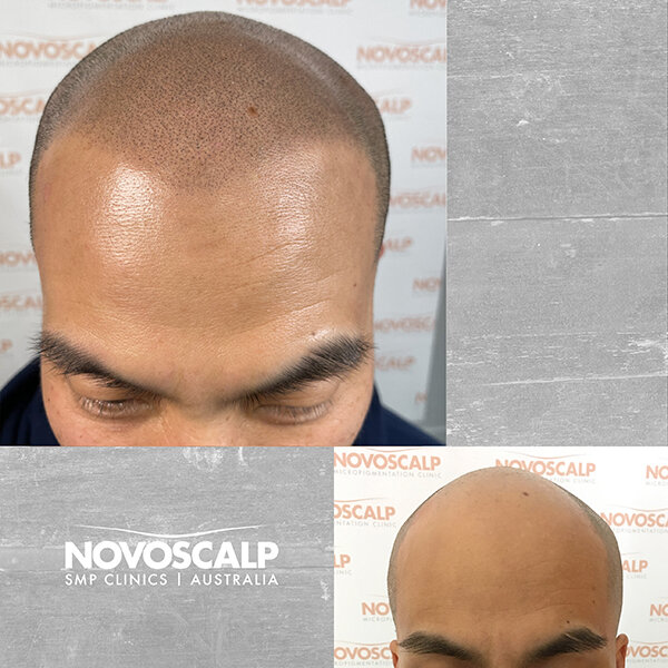 Scalp micropigmentation before and after hair tattoo for balding sydney