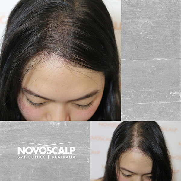 Scalp micropigmentation before and after female hair tattoo sydney