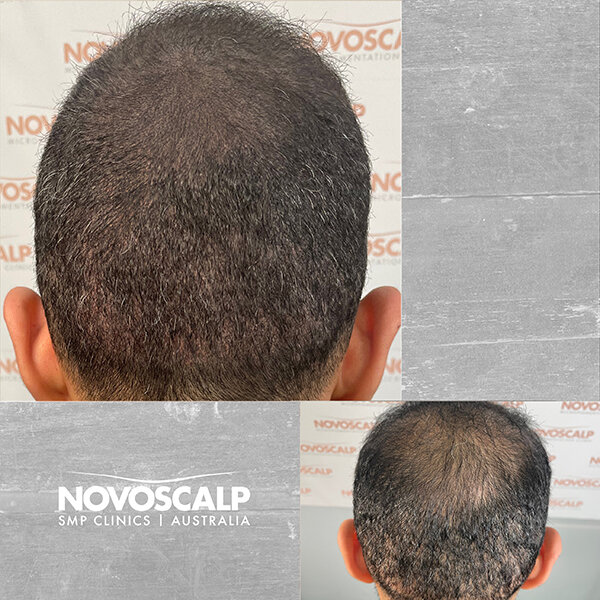 Scalp micropigmentation before and after hair tattoo for density sydney