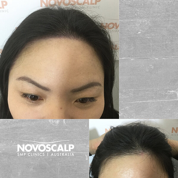 Scalp micropigmentation before and after female hairline tattoo sydney