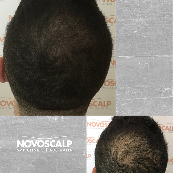 Scalp micropigmentation before and after hair tattoo for density sydney