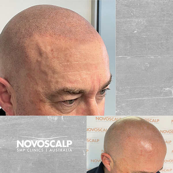 Scalp Micropigmentation Before and After Sydney