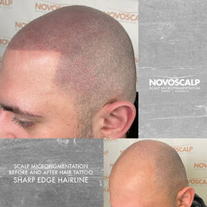 Scalp micropigmentation before and after sharp edge hairline tattoo SMP Sydney