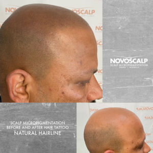 Scalp micropigmentation before and after natural hairline tattoo SMP Sydney