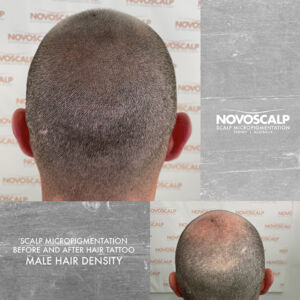 Scalp micropigmentation before and after Male SMP Hair tattoo sydney