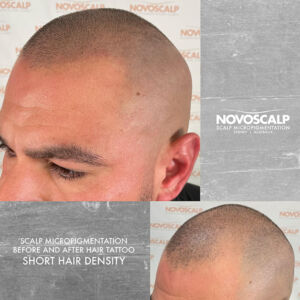 Scalp micropigmentation before and after hair density hair tattoo SMP Sydney